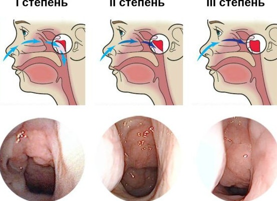 Аденоиды 1 степени у ребенка и взрослых: лечение и симптомы (фото) гипертрофии аденоидов в носу