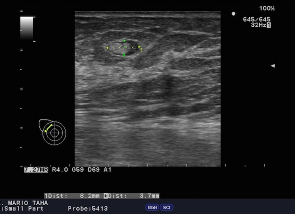 Интрамаммарный лимфоузел молочной железы: что это такое