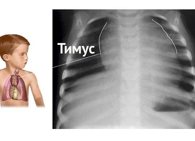 Туберкулез внутригрудных лимфоузлов у детей: лечение и прогноз