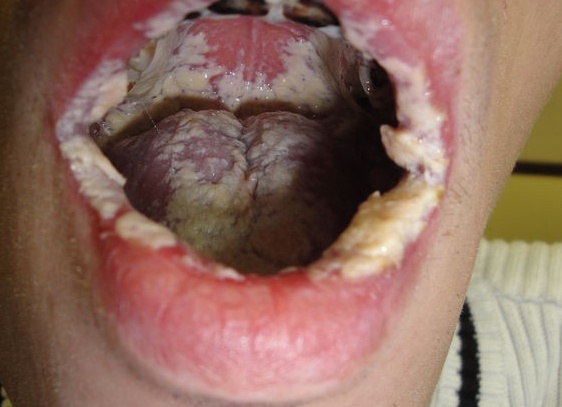 Кандидоз горла и миндалин: лечение и симптомы (фото) молочницы на гландах