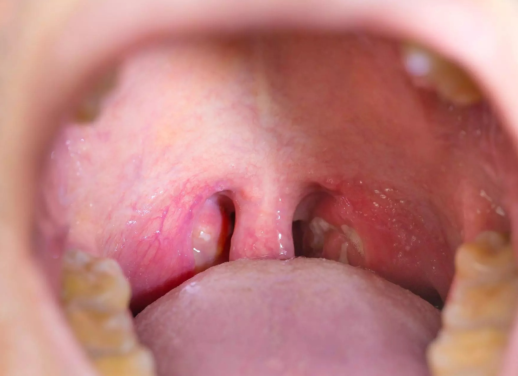 Киста на миндалине в горле (фото): чем опасна киста на гландах и что делать