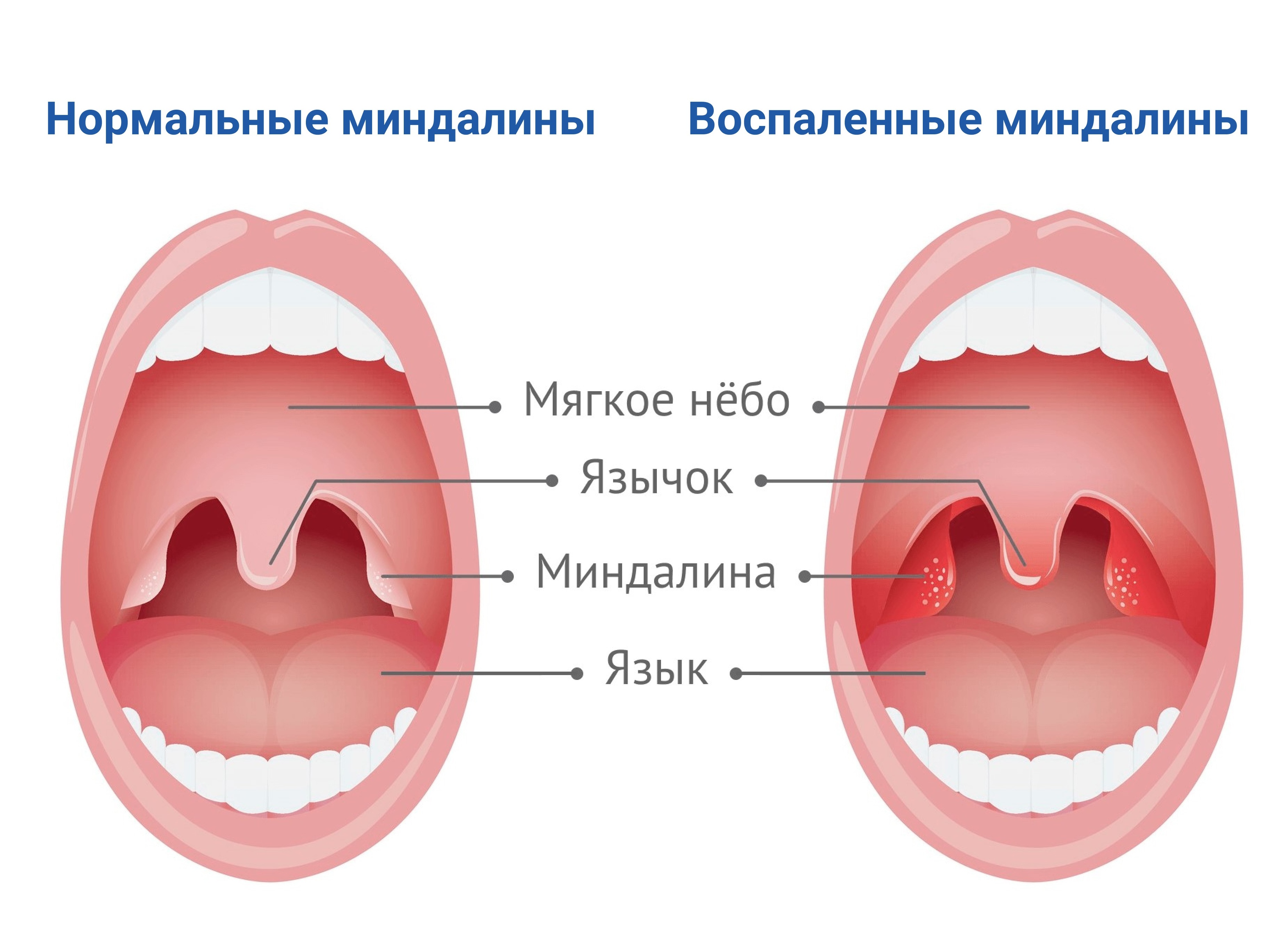 Воспалились гланды: чем и как лечить воспаленные гланды и миндалины, что делать при воспалении миндалин?