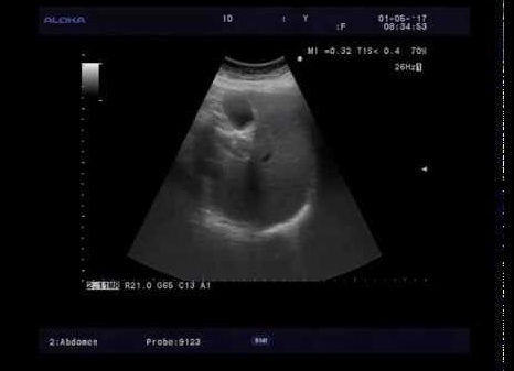 Лимфаденопатия ворот печени: что это такое, причины увеличения лимфоузлов