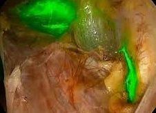 Рак лимфоузлов: симптомы и признаки онкологии, лечение и прогноз