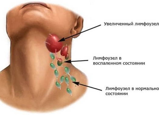 Гиперплазия лимфоузлов: что это такое, причины разрастания лимфоидной ткани Гиперплазия лимфоузлов: что это такое, причины разрастания лимфоидной ткани