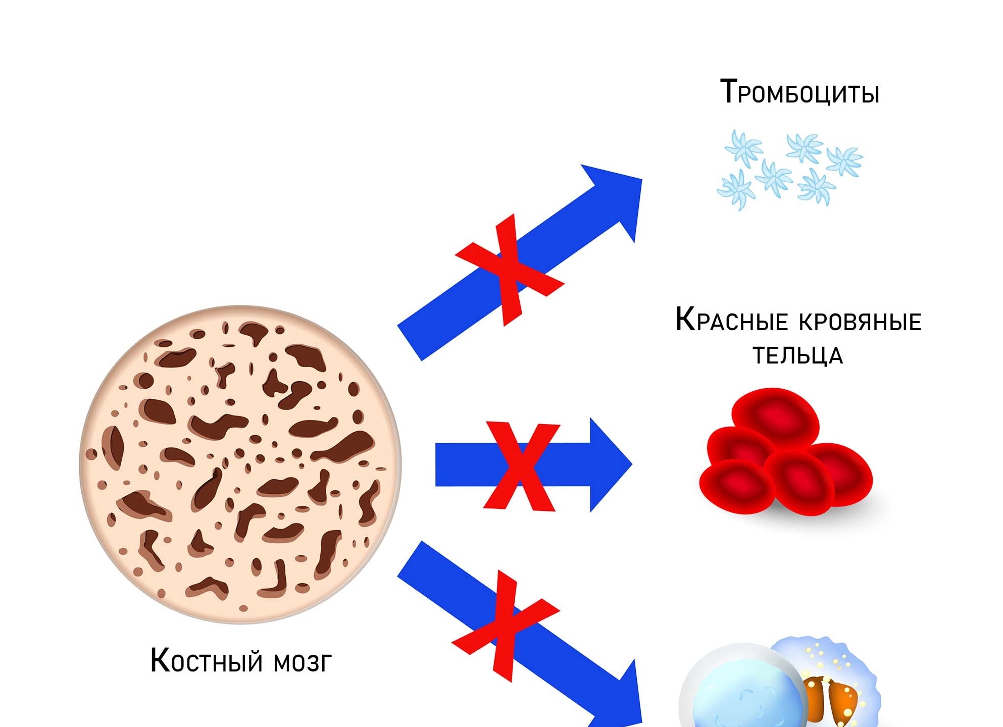 Апластическая анемия: суть заболевания, его симптоматика, диагностика и лечение