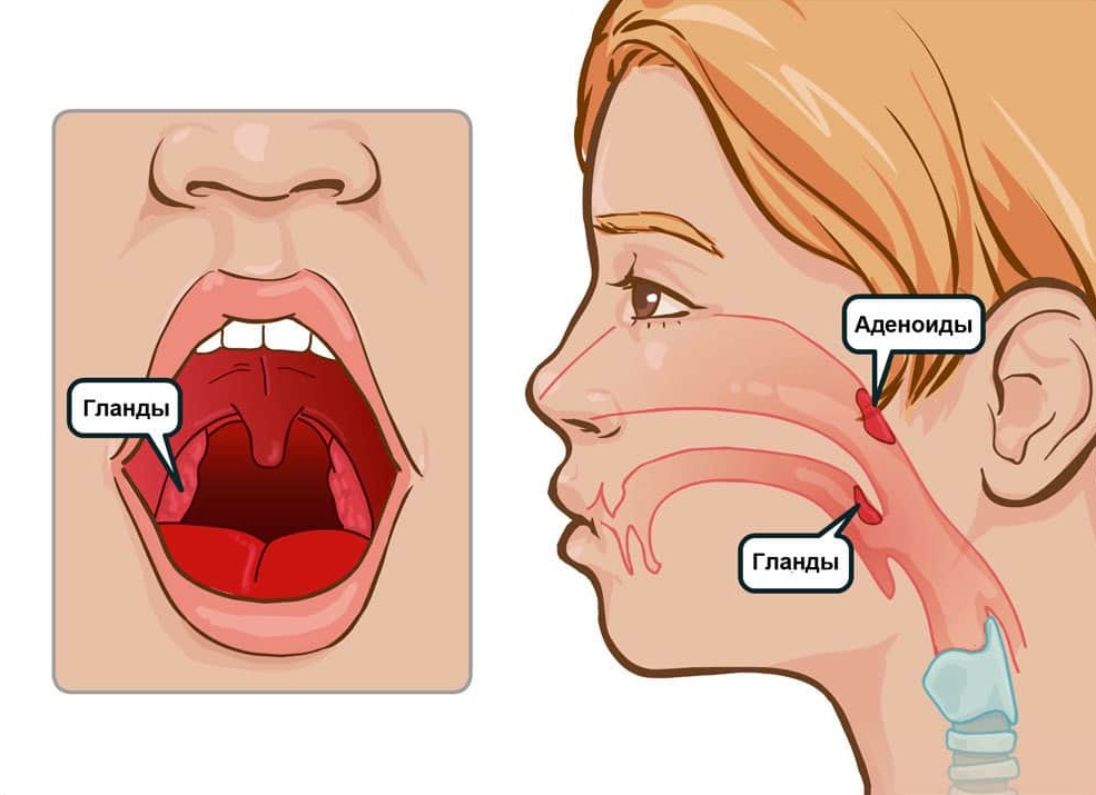 Народные средства от аденоидов у детей: как лечить в домашних условиях аденоиды у ребенка