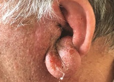 Паратонзиллярный абсцесс: код по мкб-10, симптомы (фото) и лечение паратонзиллита