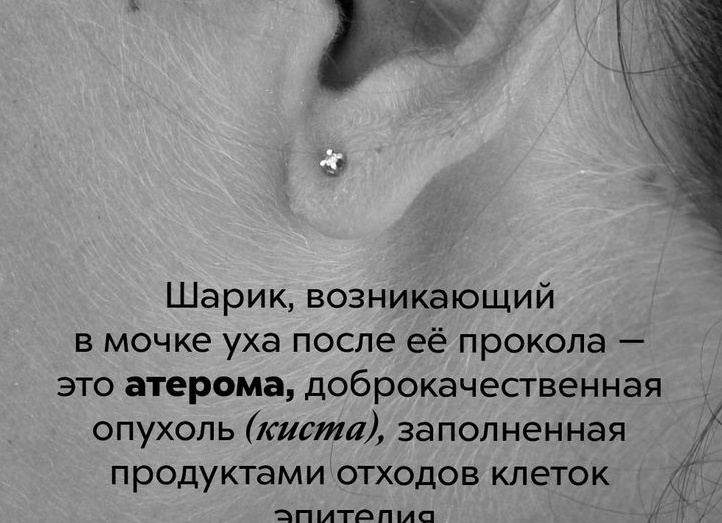 Шарик на мочке уха: что это такое, причины образования такого уплотнения, почему болит такая шишка?