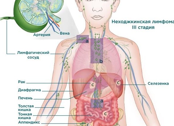 Лимфома средостения: что это, симптомы и лечение