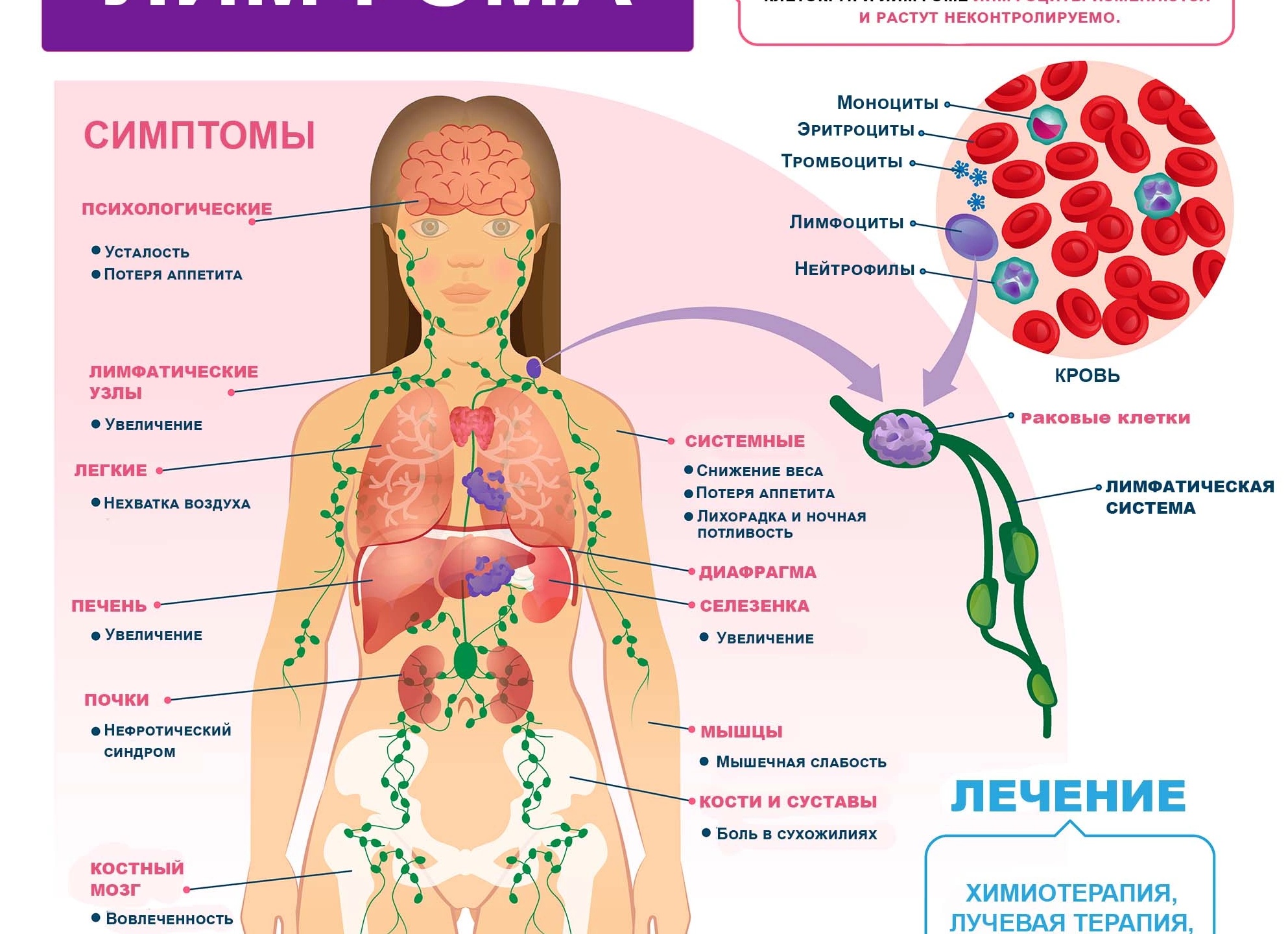 Лимфома легких: что это такое, симптомы и прогноз