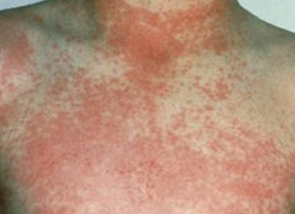 Скарлатина у беременных: чем опасна болезнь на ранних сроках, лечение при беременности