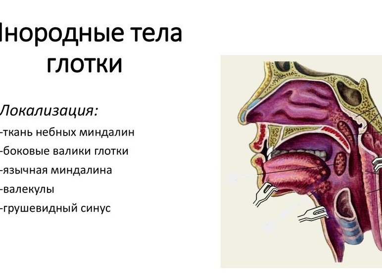 Как будто что-то прилипло в горле: причины, борьба, профилактика