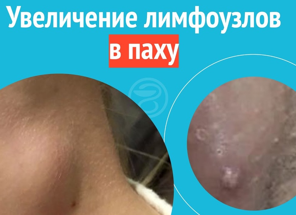 Лимфоузлы в паху у ребенка: причины увеличения у детей