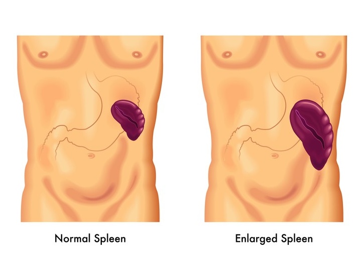 Спленомегалия: что это такое, как лечить увеличение селезенки