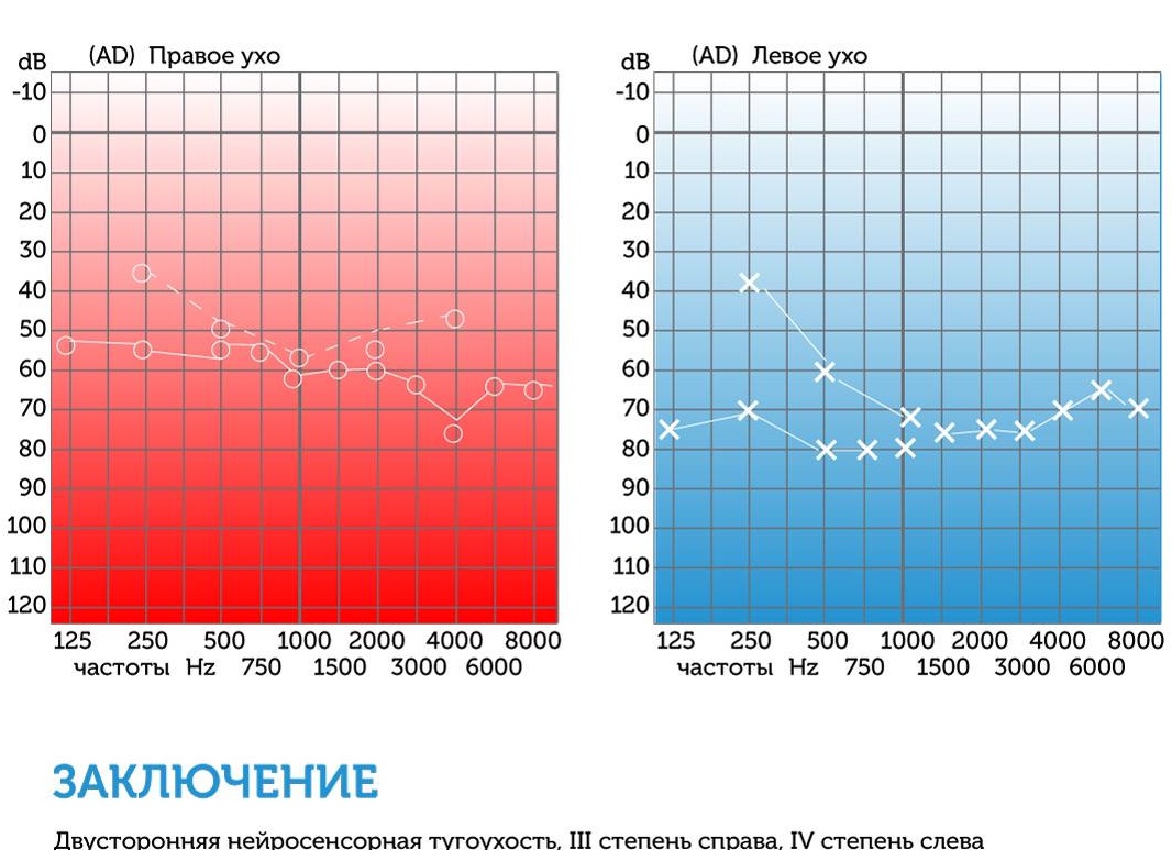 Аудиограмма слуха: показания к проведению аудиометрии, методы исследования, расшифровка таблицы