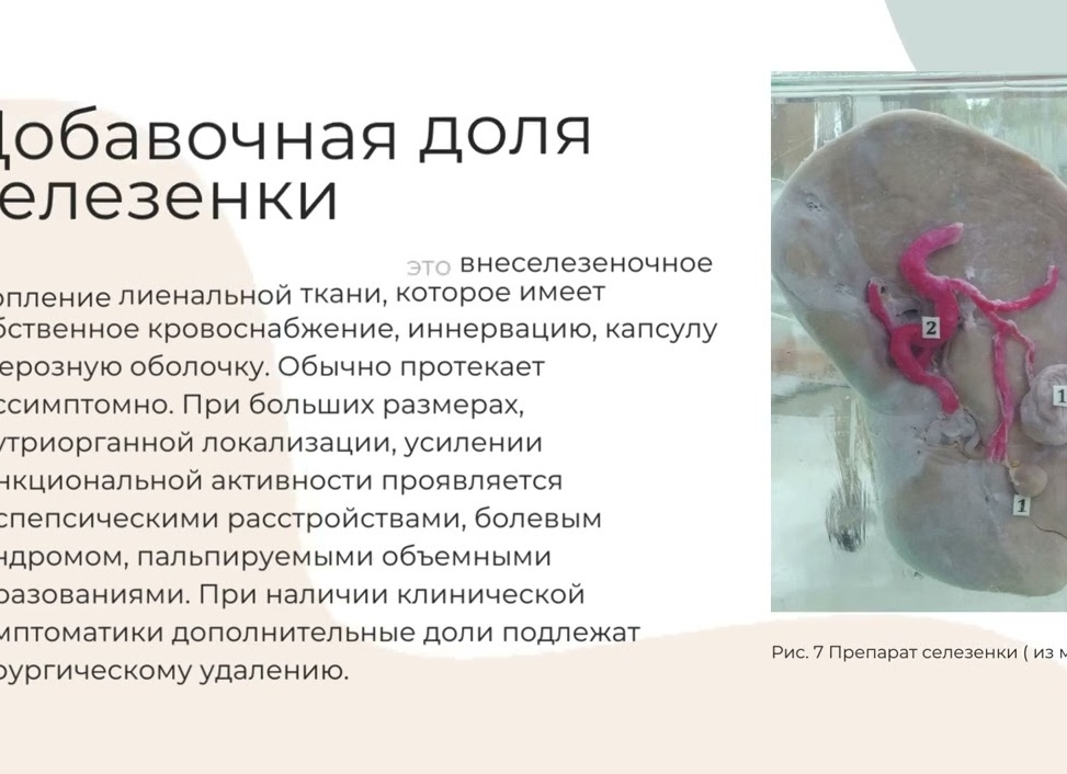 Добавочная долька селезенки: что это такое, признаки дополнительной дольки