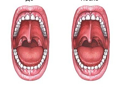 Последствия удаления миндалин у взрослых и детей: отзывы об осложнениях после удаления гланд