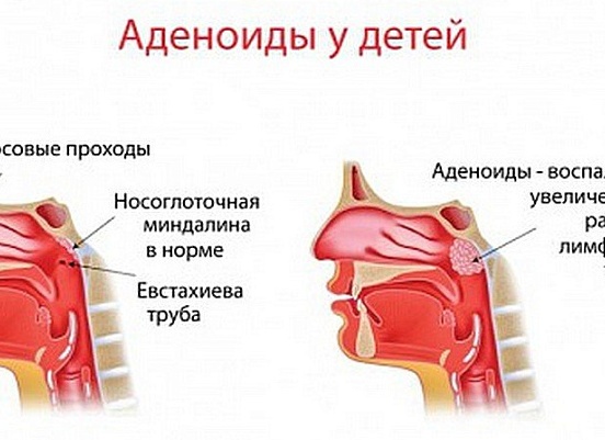 Хронический аденоидит у детей: лечение и симптомы, код по мкб-10