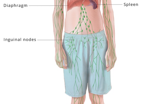 Лимфома беркитта: что это такое, симптомы и прогноз болезни