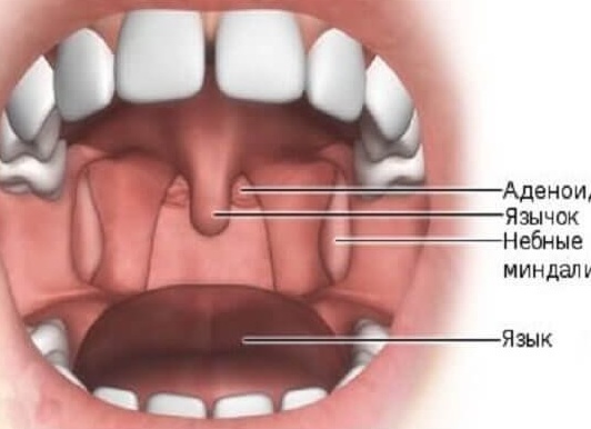 Где находятся аденоиды у ребенка: как выглядят аденоиды в носу (фото)