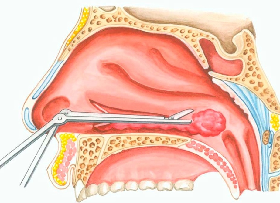 Вазотомия носовых раковин: что это такое, причины проведения операции в нижней части носа и её виды