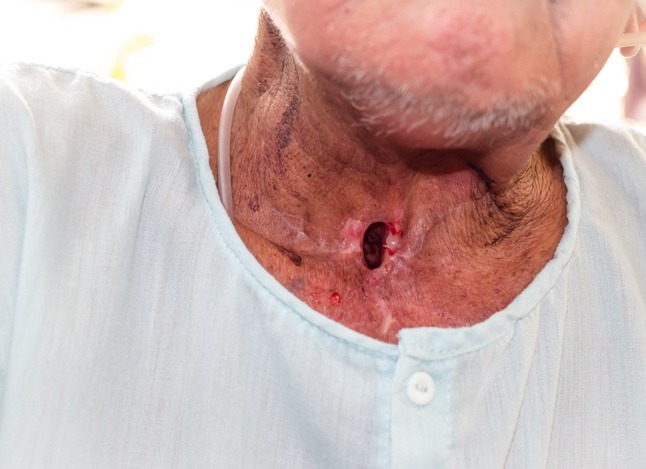 Рак гортани: симптомы и признаки опухоли в гортани у женщин и мужчин на разных стадиях, фото горла